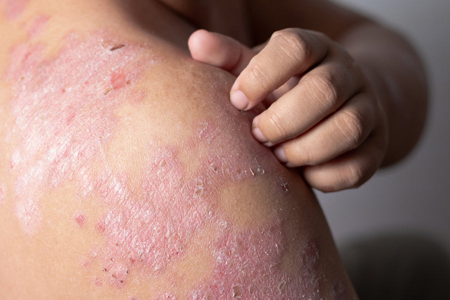 The difference between Eczema and Psoriasis